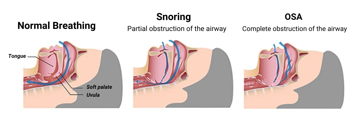 Diagram showing normal vs snoring vs sleep apnea effects on the throat. Snoring is partial obstruction of the airway and Obstructive Sleep apnea is complete obstruction of the airway