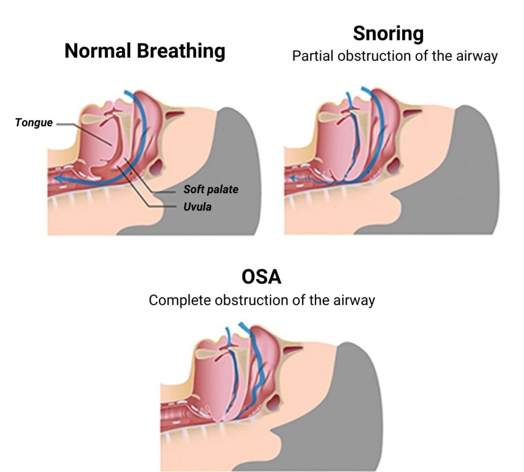 Diagram showing normal breathing during sleep VS snoring (partial obstruction of the airway) VS sleep apnea (complete obstruction of the airway)