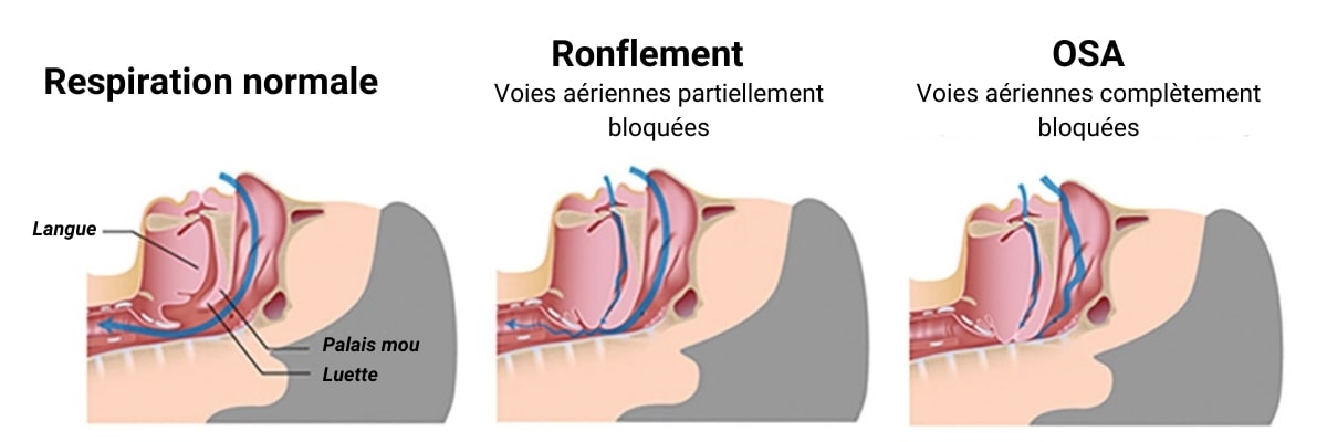 diagrammes de gorges avec respiration normale, ronflement et apnée